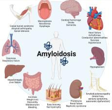 What Are the Common Signs and Symptoms of Amyloidosis?